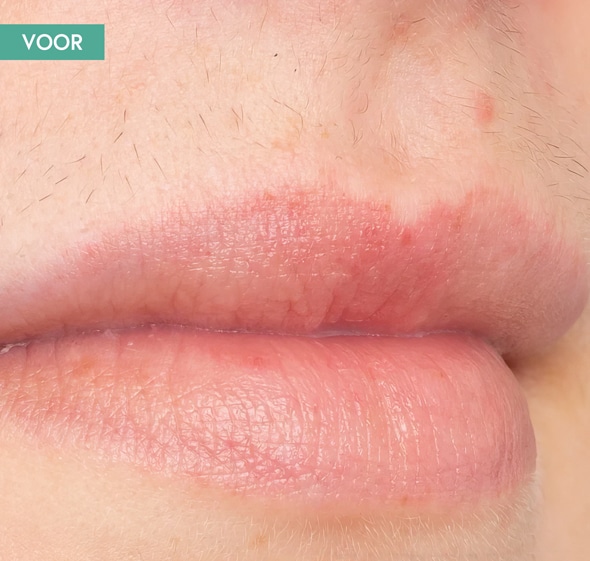foto van voor ontharen lippen met laser